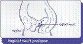diagram of vaginal vault prolapse