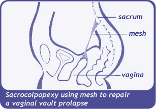 image of sacrocolpopexy